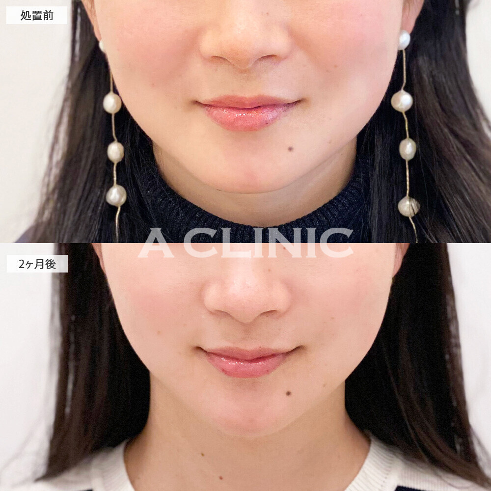 1day小顔脂肪吸引とあごへのヒアルロン酸注入でどこから見ても綺麗なVフェイスになりました!処置前と2ヶ月後の症例です(20代女性)