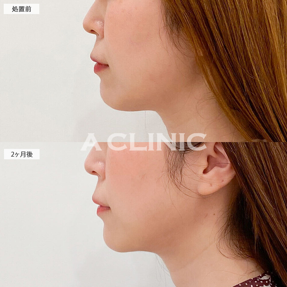 1day小顔脂肪吸引でダイエットでも落ちにくいあご下の脂肪もスッキリなくなりました！処置前と2ヶ月後の症例です(20代女性)