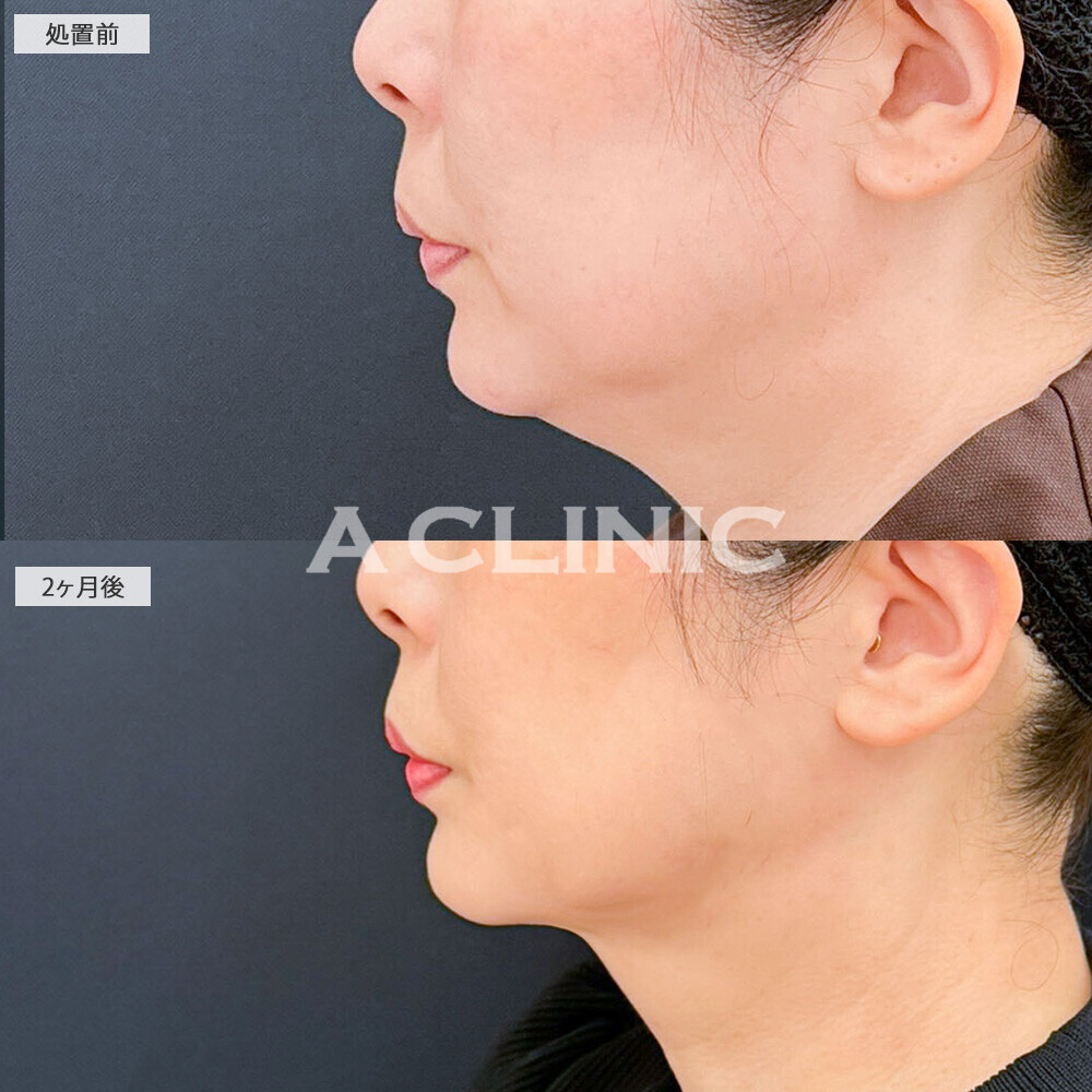 1day小顔脂肪吸引であご下の脂肪とたるみが無くなり若々しい印象になりました！処置前から2ヶ月後の症例です(50代女性)