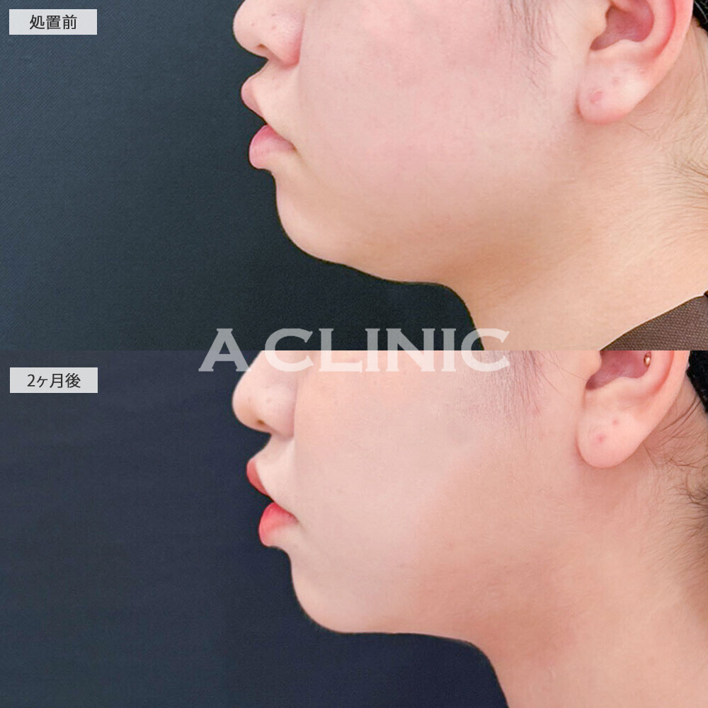 1day小顔脂肪吸引を受けると別人級の変化で垢抜け成功!処置前から2ヶ月後の症例です(10代女性)