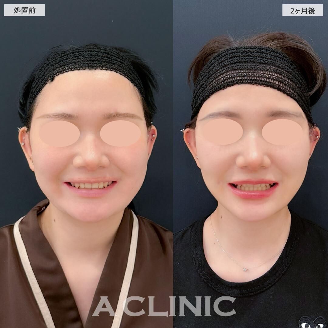 1day小顔脂肪吸引とバッカルファット除去術と小顔エラボトックスで輪郭がシュッとしっかり小顔に！こちら処置前と2ヶ月後の症例です(10代女性)