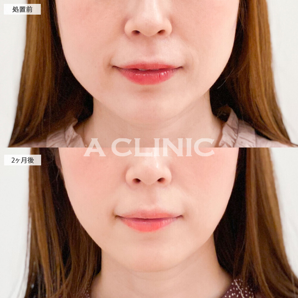 1day小顔脂肪吸引でダイエットでも落ちにくいあご下の脂肪もスッキリなくなりました！処置前と2ヶ月後の症例です(20代女性)