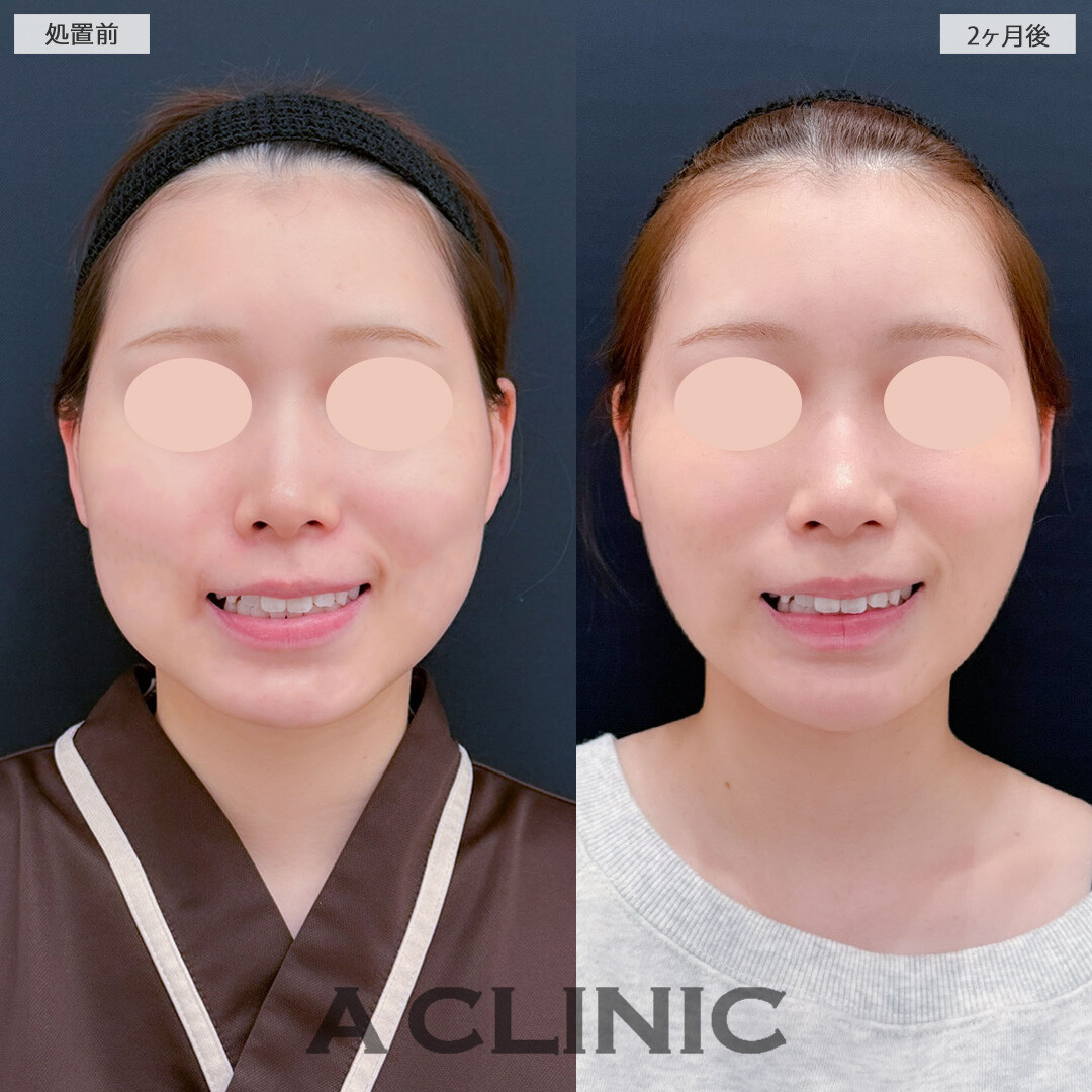 1day小顔脂肪吸引とバッカルファット除去術と小顔エラボトックスで輪郭がスッキリ小顔になりました！こちら処置前と2ヶ月後の症例です(20代女性)