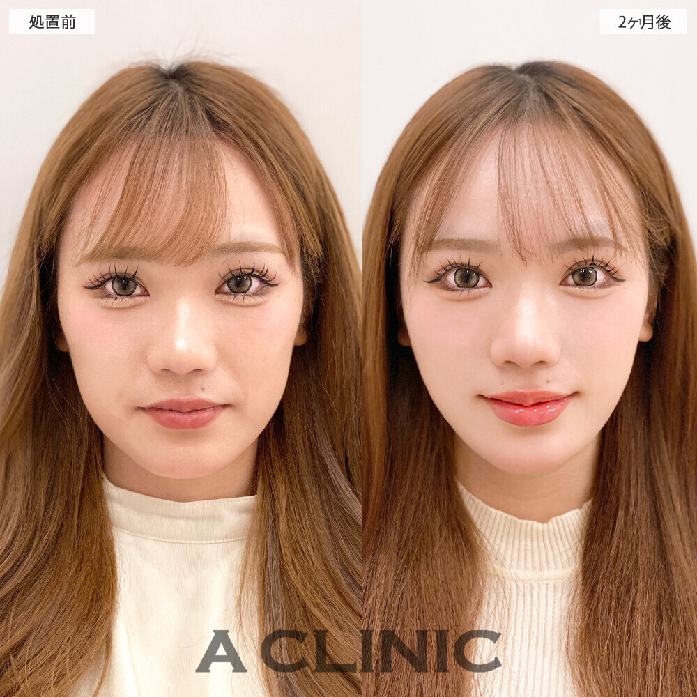 1day小顔脂肪吸引で顔の四角さがなくなり垢抜けました！こちら処置前から2ヶ月後の症例です(20代女性)