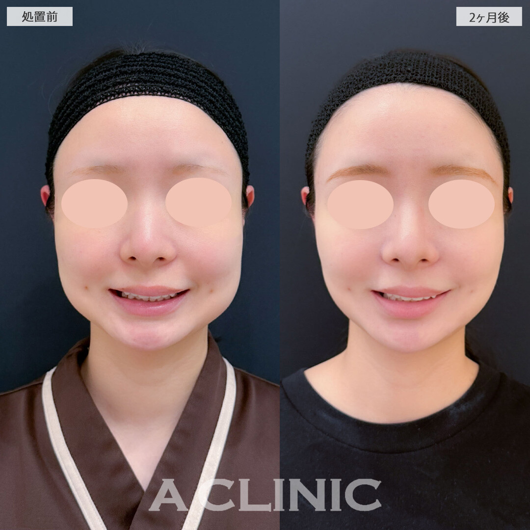 1day小顔脂肪吸引とバッカルファット除去術と小顔エラボトックスで下膨れが解消され輪郭がシュッとしました！こちら処置前と2ヶ月後の症例です(20代女性)