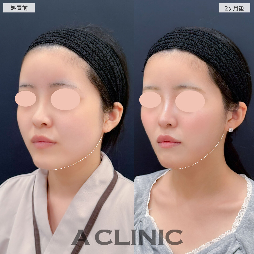 1day小顔脂肪吸引と小顔エラボトックスでナチュラルだけどしっかり小顔になれます！こちら処置前2ヶ月後の症例です(20代女性)
