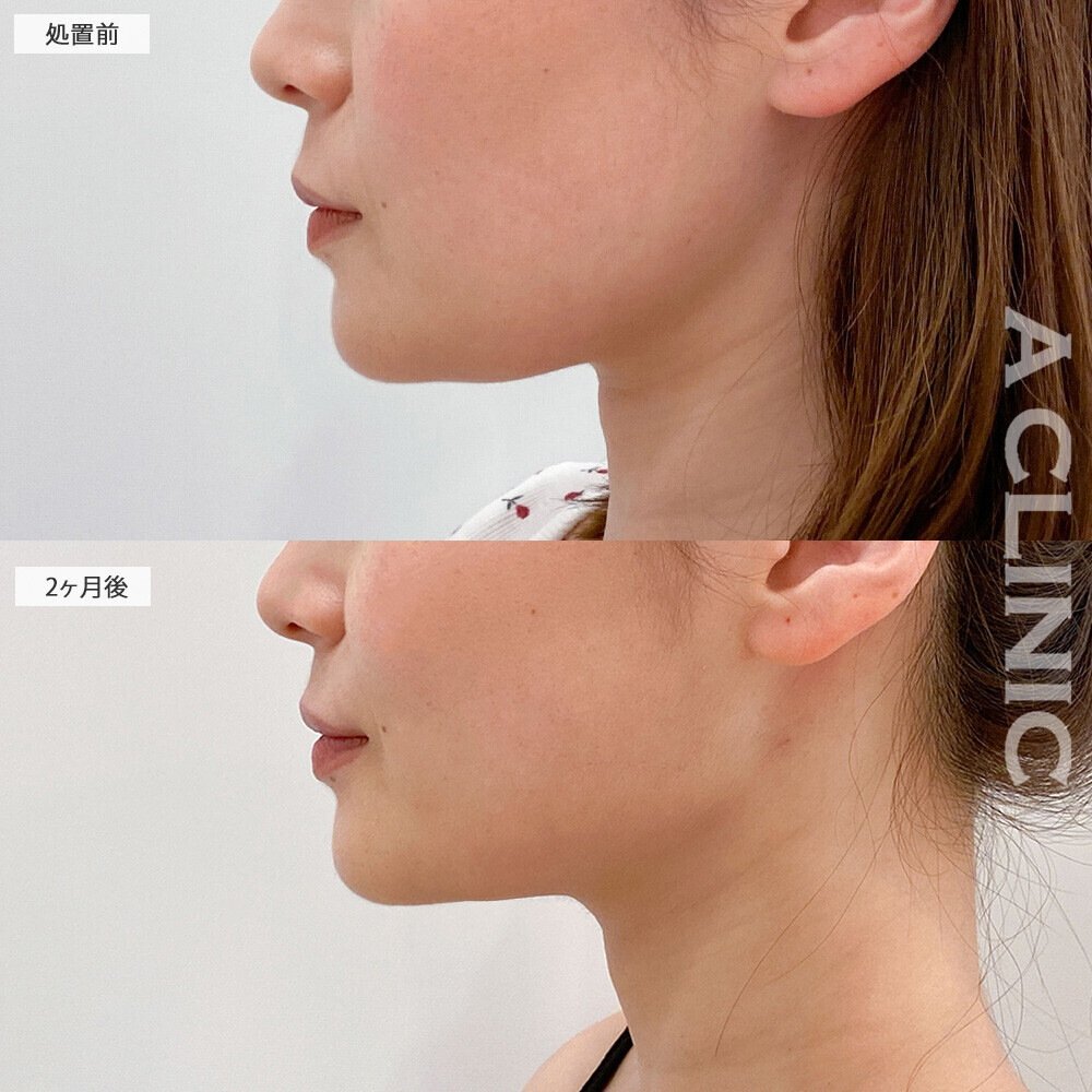 1day小顔脂肪吸引で顔の余白がなくなり若返りました！こちら処置前から2ヶ月後の症例です(30代女性)