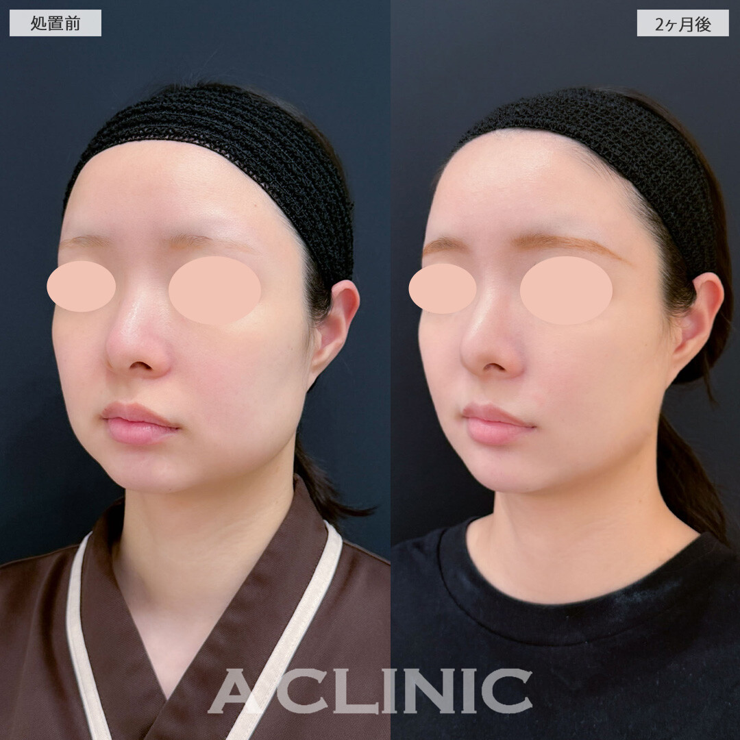 1day小顔脂肪吸引とバッカルファット除去術と小顔エラボトックスで下膨れが解消され輪郭がシュッとしました！こちら処置前と2ヶ月後の症例です(20代女性)