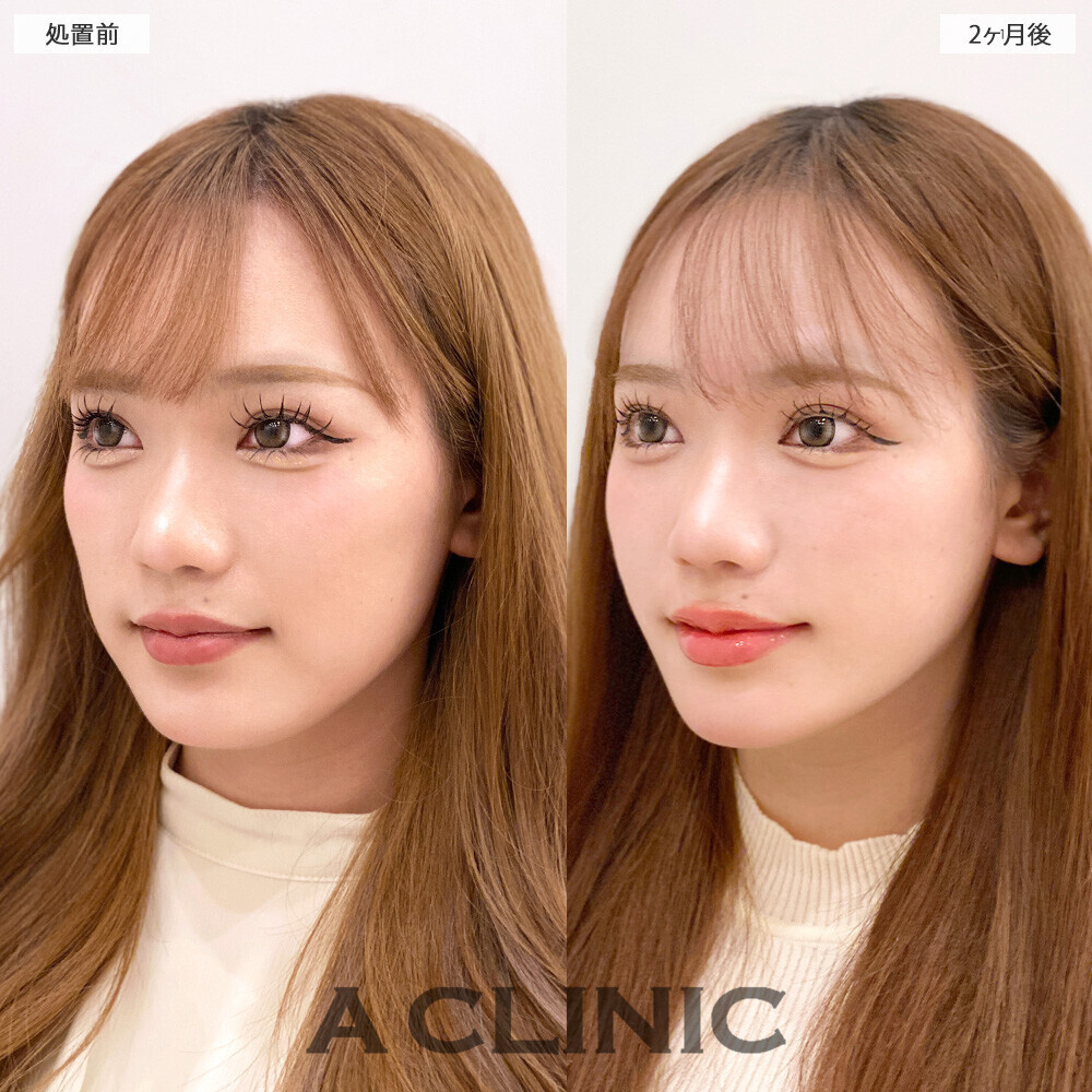 1day小顔脂肪吸引で顔の四角さがなくなり垢抜けました！こちら処置前から2ヶ月後の症例です(20代女性)