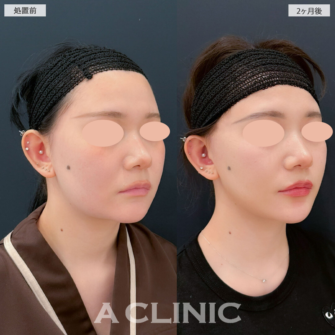 1day小顔脂肪吸引とバッカルファット除去術と小顔エラボトックスで輪郭がシュッとしっかり小顔に！こちら処置前と2ヶ月後の症例です(10代女性)