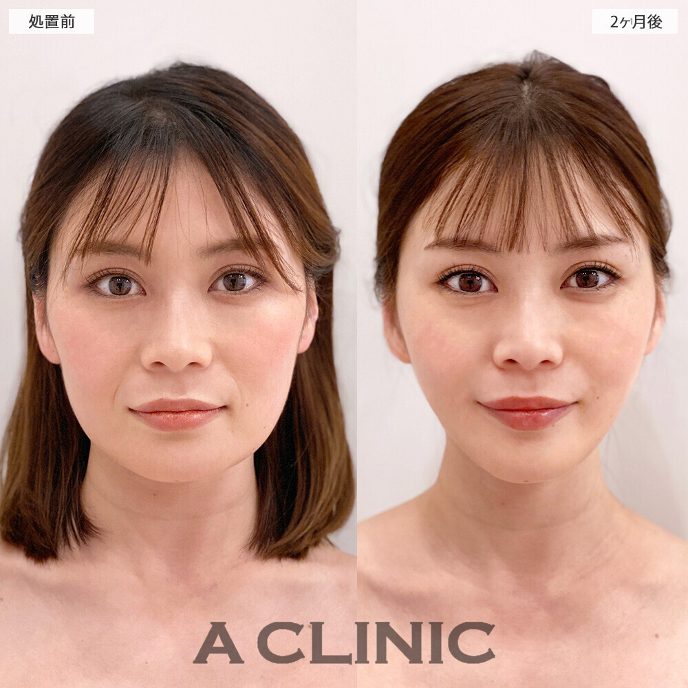 1day小顔脂肪吸引で顔の余白がなくなり若返りました！こちら処置前から2ヶ月後の症例です(30代女性)