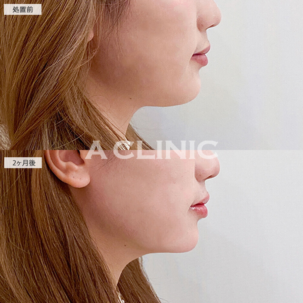 1day小顔脂肪吸引で顔の四角さがなくなり垢抜けました！こちら処置前から2ヶ月後の症例です(20代女性)