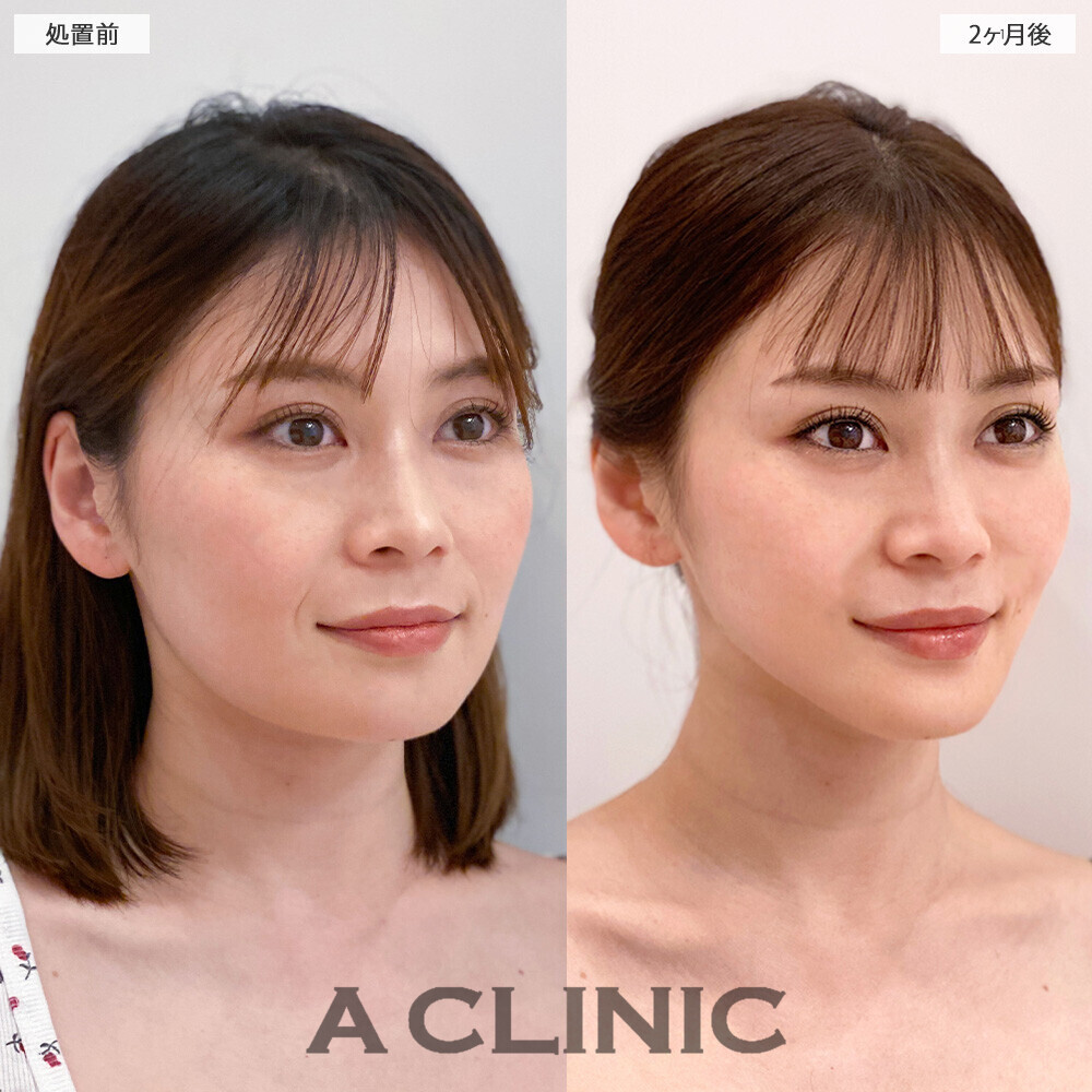 1day小顔脂肪吸引で顔の余白がなくなり若返りました！こちら処置前から2ヶ月後の症例です(30代女性)