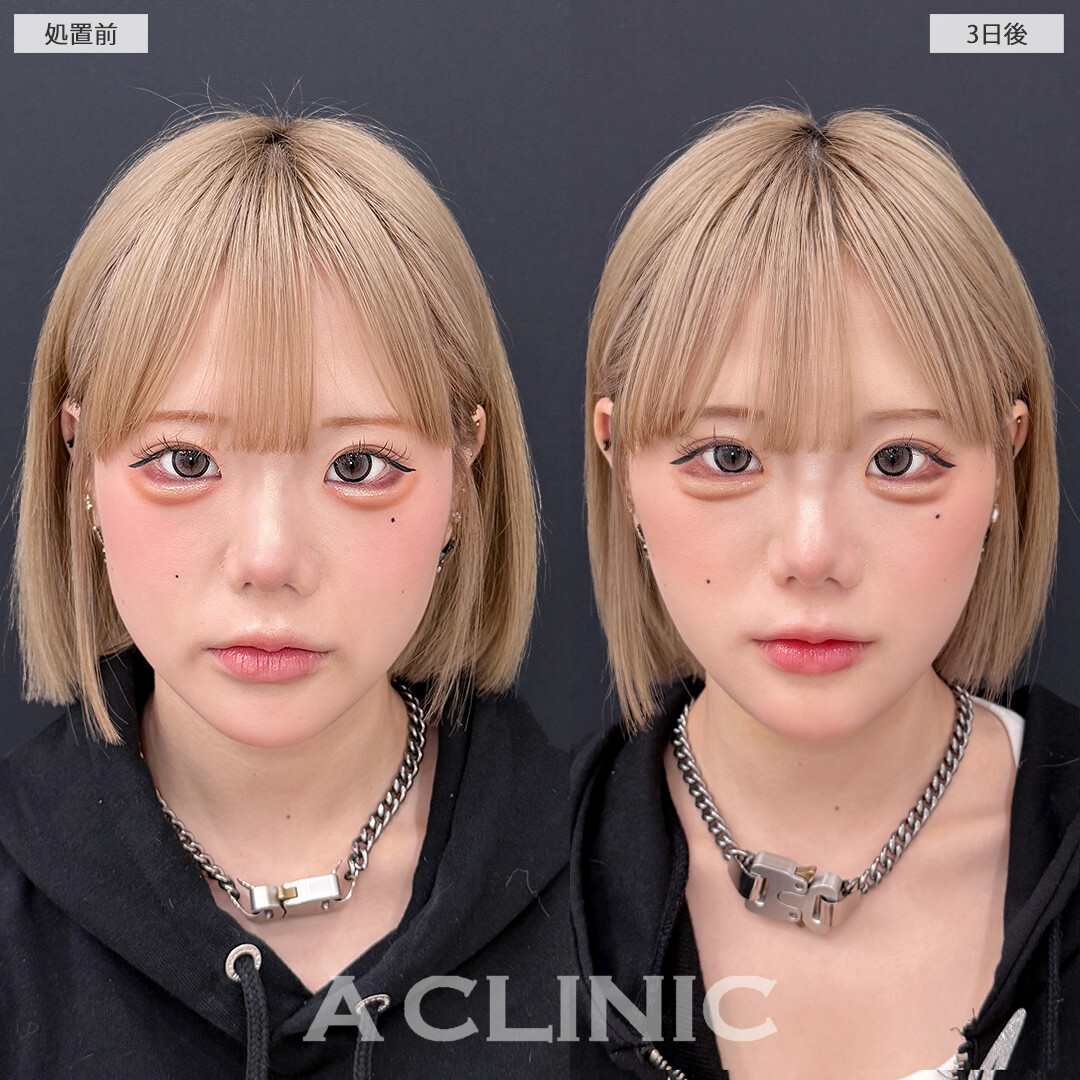 1day小顔脂肪吸引なら施術3日後でも余裕でお出かけできます！こちら処置前と3日後の症例です(20代女性)