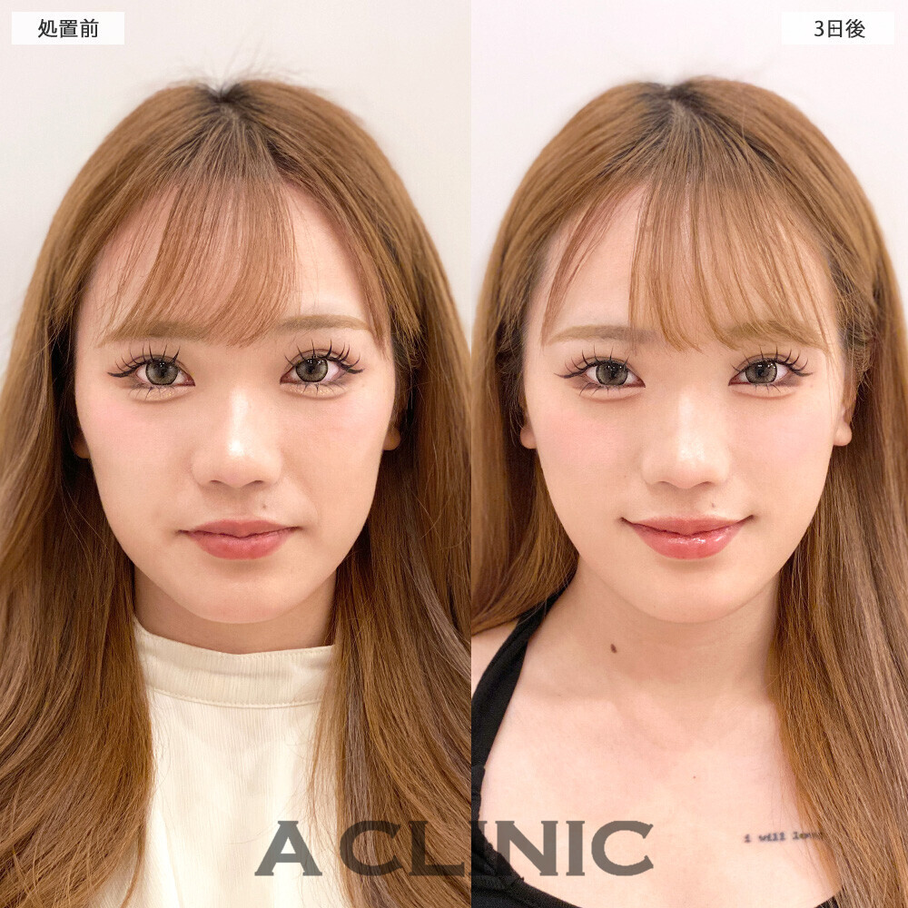1day小顔脂肪吸引で顔の四角さがなくなり垢抜けました！こちら処置前から2ヶ月後の症例です(20代女性)