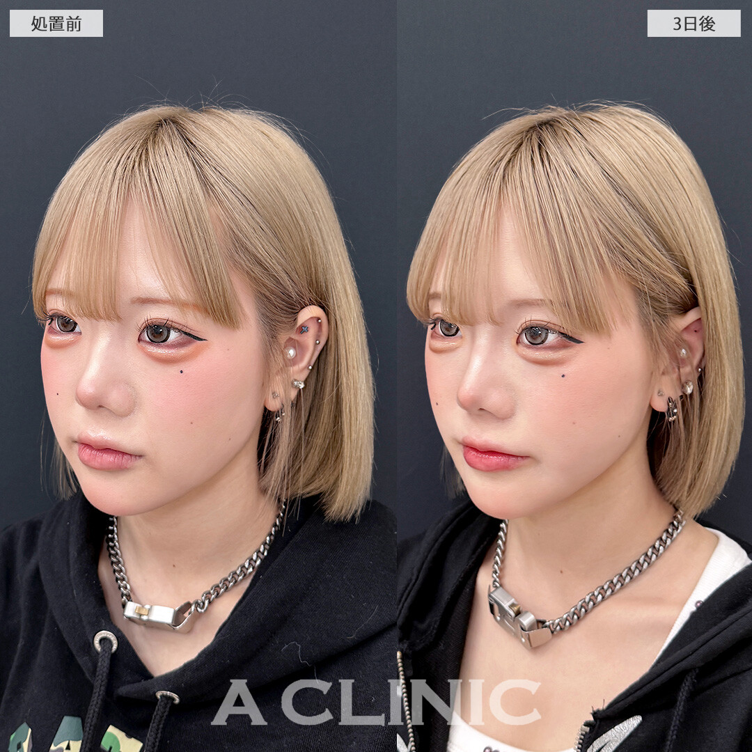 1day小顔脂肪吸引なら施術3日後でも余裕でお出かけできます！こちら処置前と3日後の症例です(20代女性)