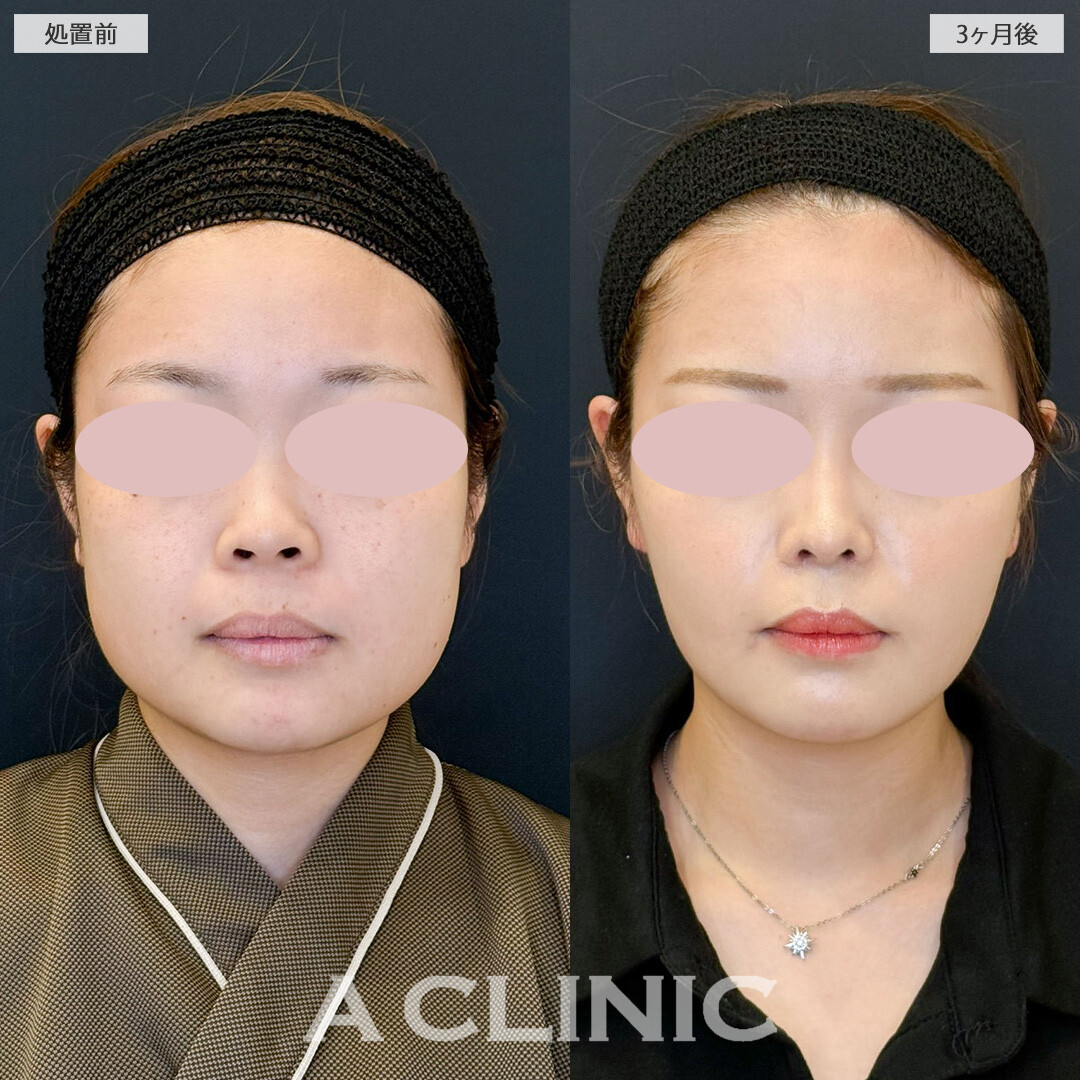 1day小顔脂肪吸引と小顔エラボトックスで憧れのVフェイスに！こちら処置前と3ヶ月後の症例です(20代女性)