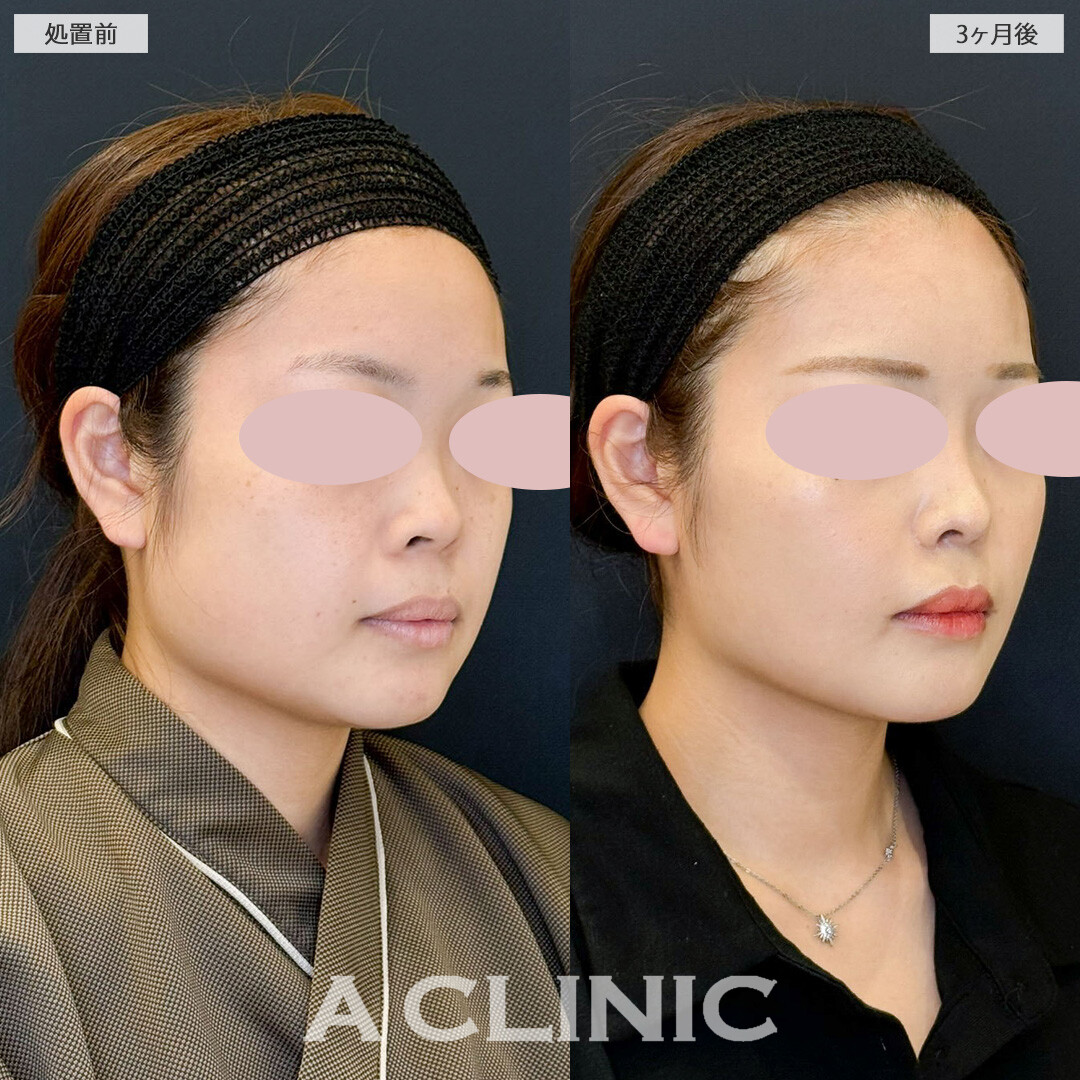 1day小顔脂肪吸引と小顔エラボトックスで憧れのVフェイスに！こちら処置前と3ヶ月後の症例です(20代女性)
