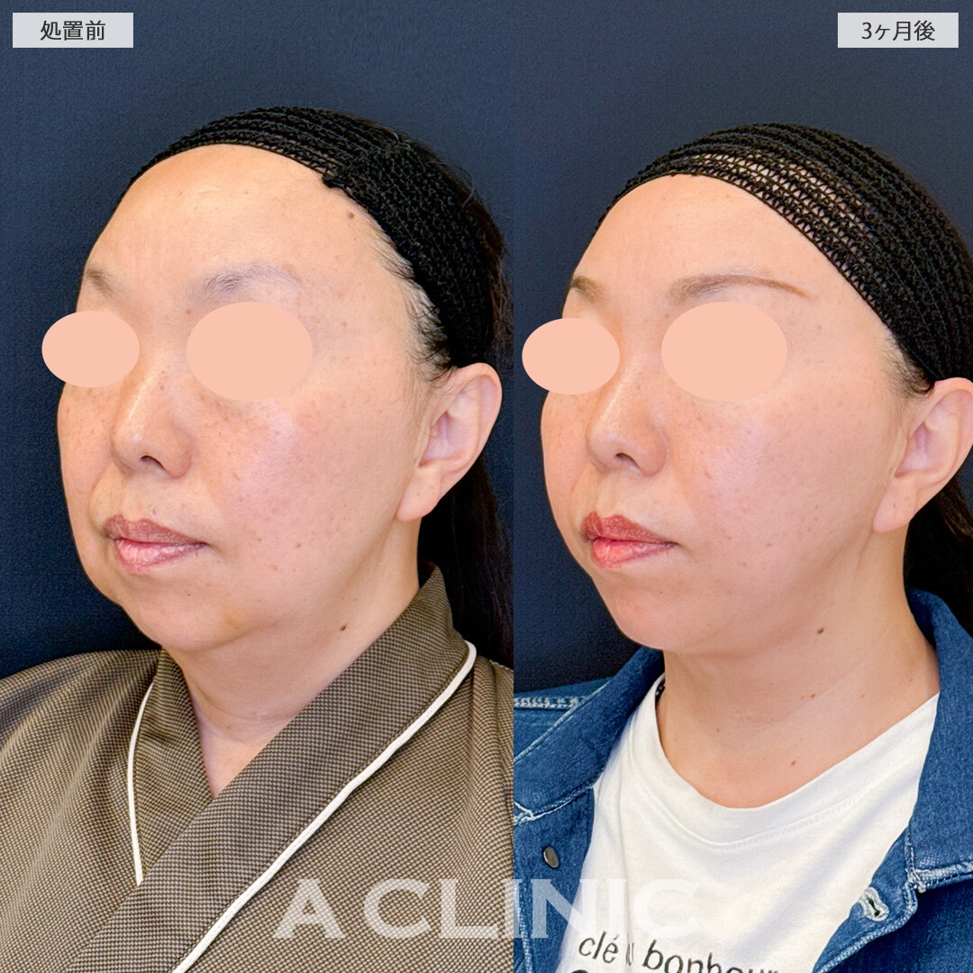 1day小顔脂肪吸引でフェイスライン引き締めてたるみとおさらば!処置前と3ヶ月後の症例です(50代女性)