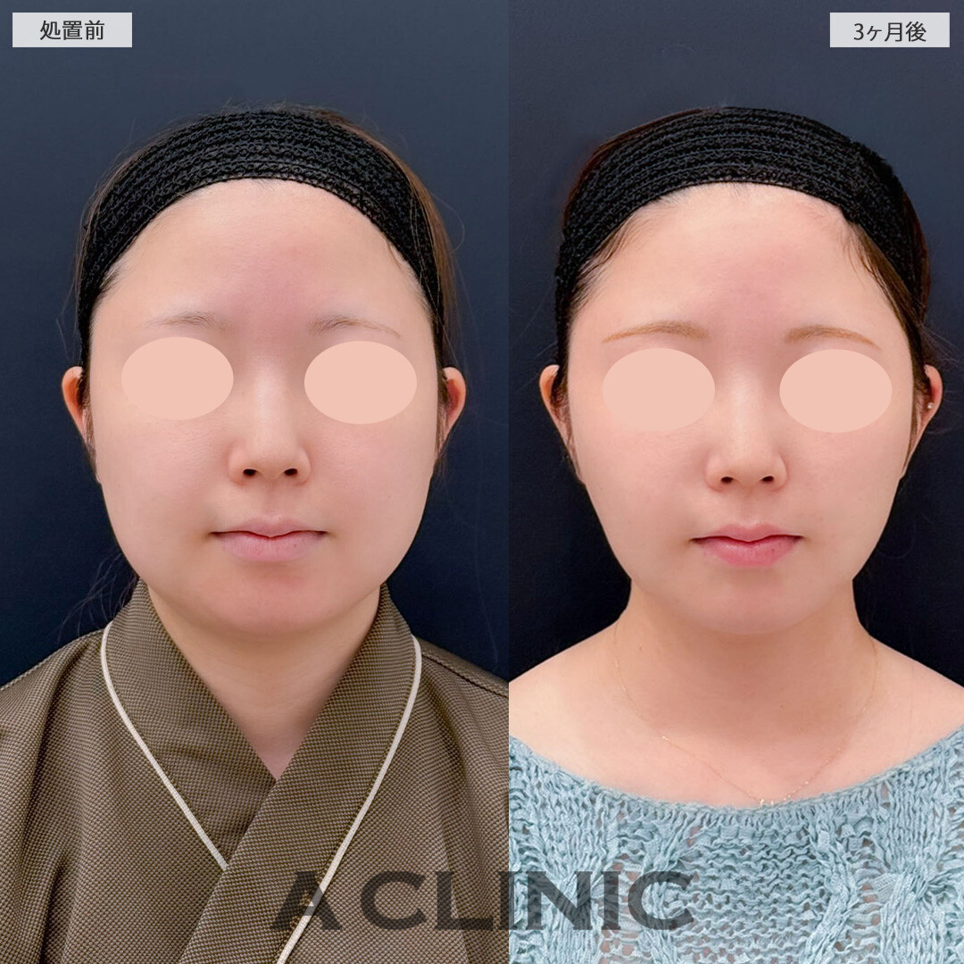 1day小顔脂肪吸引と小顔エラボトックスでフェイスラインがしっかり引きあがり下膨れも解消しました！こちら処置前と3ヶ月後の症例です(20代女性)