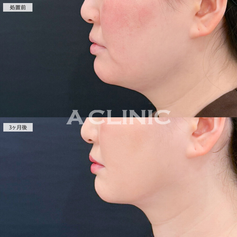 1day小顔脂肪吸引で脂肪ゼロのペラペラなあご下に!処置前から3ヶ月後の症例です(30代女性)