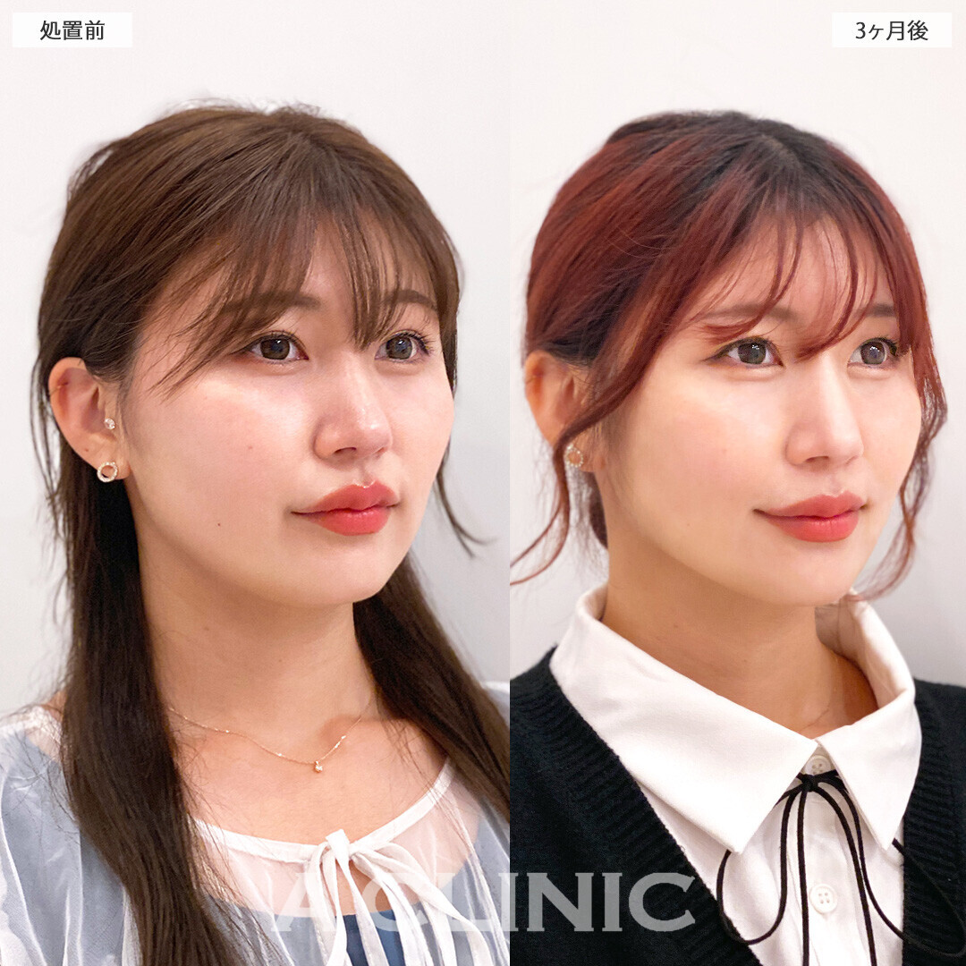 1day小顔脂肪吸引で脂肪が減りスッキリした印象になりました!処置前と3ヶ月後の症例です(30代女性)
