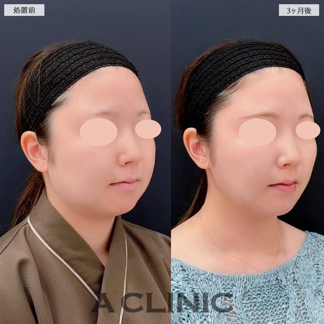 1day小顔脂肪吸引と小顔エラボトックスでフェイスラインがしっかり引きあがり下膨れも解消しました！こちら処置前と3ヶ月後の症例です(20代女性)