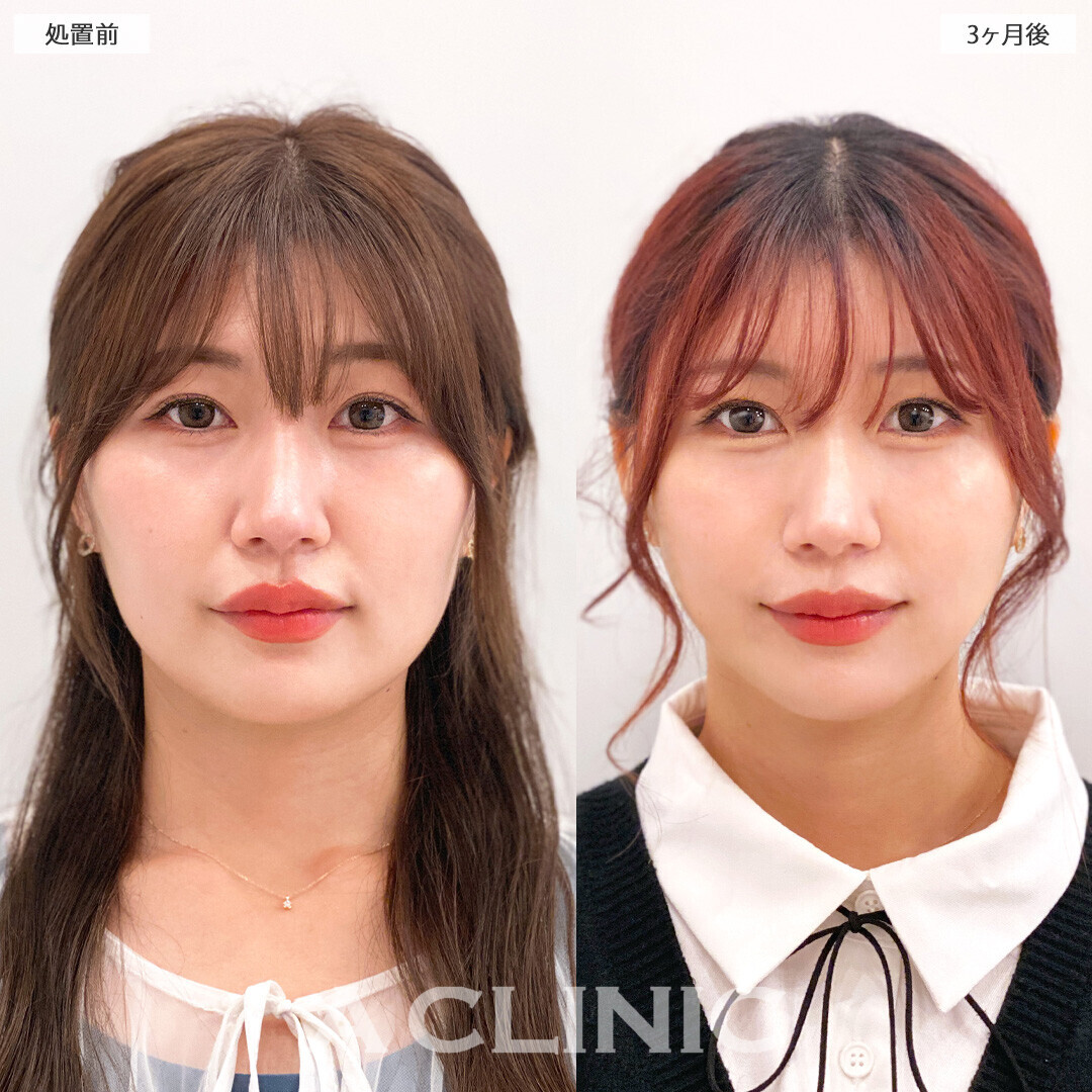 1day小顔脂肪吸引で脂肪が減りスッキリした印象になりました!処置前と3ヶ月後の症例です(30代女性)