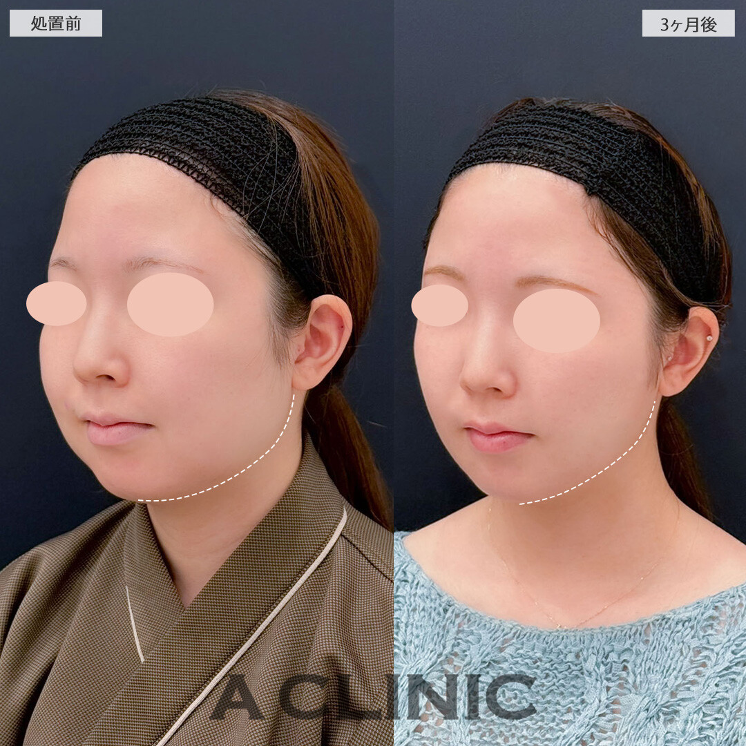 1day小顔脂肪吸引と小顔エラボトックスでフェイスラインがしっかり引きあがり下膨れも解消しました！こちら処置前と3ヶ月後の症例です(20代女性)