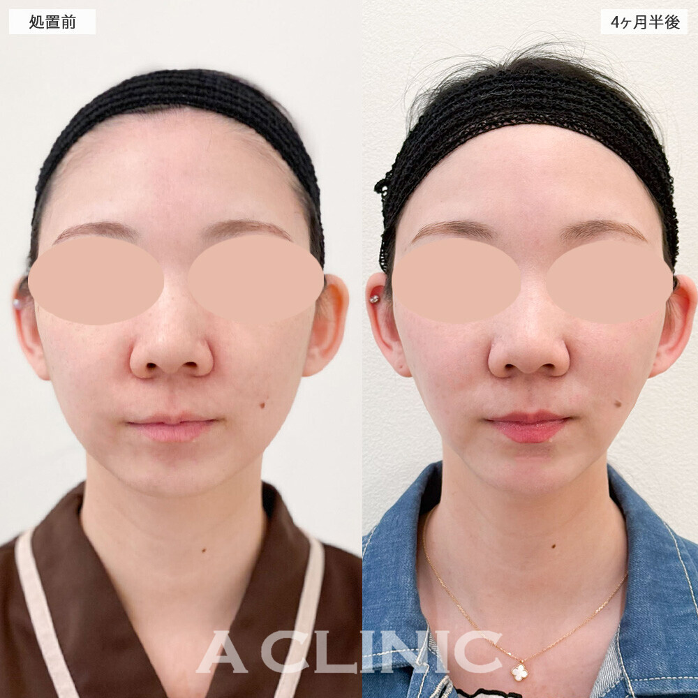 1day小顔脂肪吸引と小顔エラボトックスで余白のない卵型の輪郭に！こちら処置前から4ヶ月半後の症例です(30代女性)