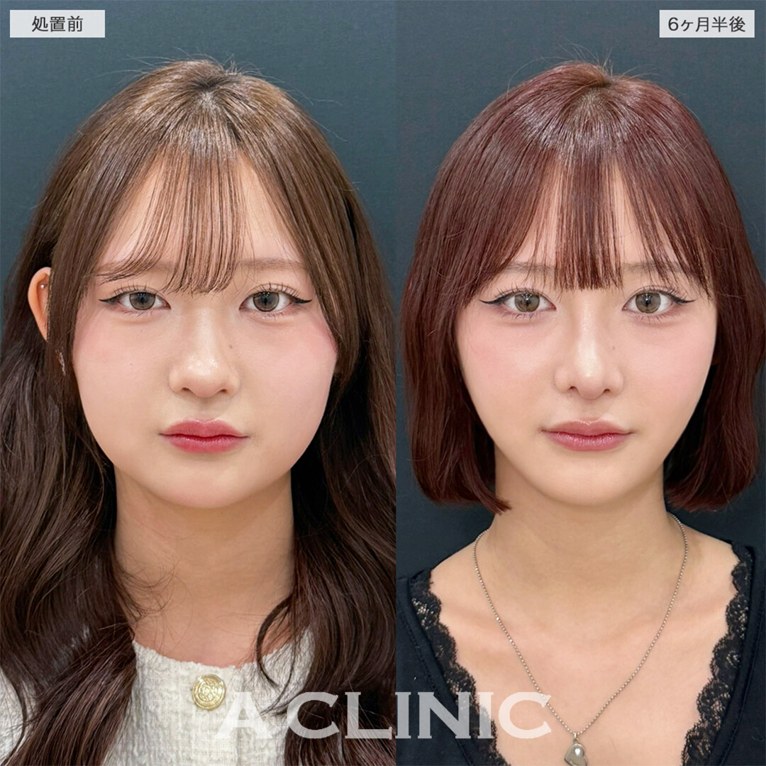 1day小顔脂肪吸引とバッカルファット除去術は半年経過しても綺麗な輪郭保てます！こちら処置前と6ヶ月半後の症例です(10代女性)