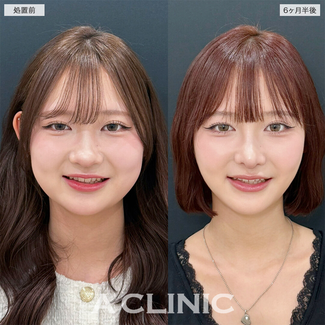 1day小顔脂肪吸引とバッカルファット除去術は半年経過しても綺麗な輪郭保てます！こちら処置前と6ヶ月半後の症例です(10代女性)