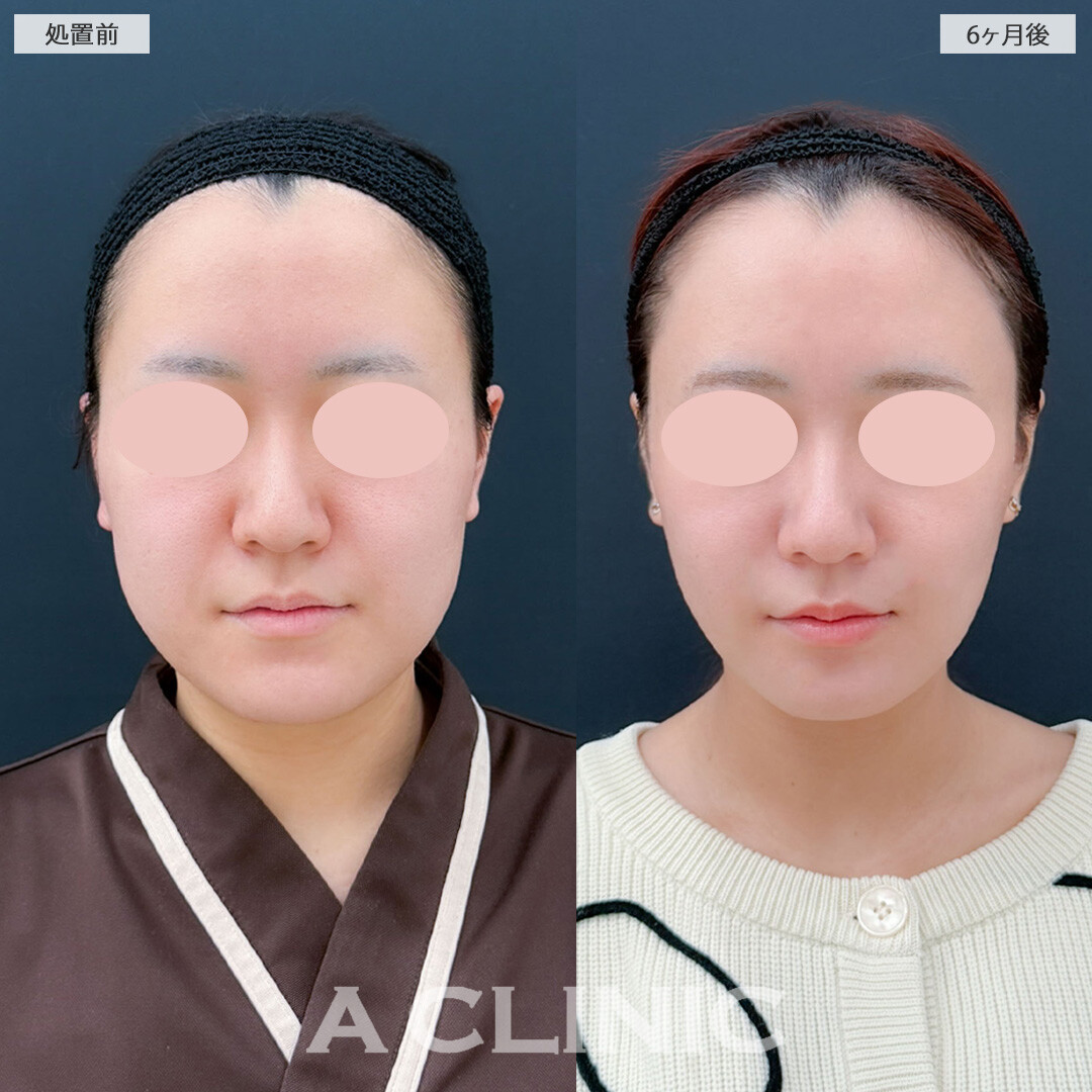 1day小顔脂肪吸引とバッカルファット除去術と小顔エラボトックスでスッキリ一回り小顔になりました！こちら処置前と6ヶ月後の症例です(20代女性)