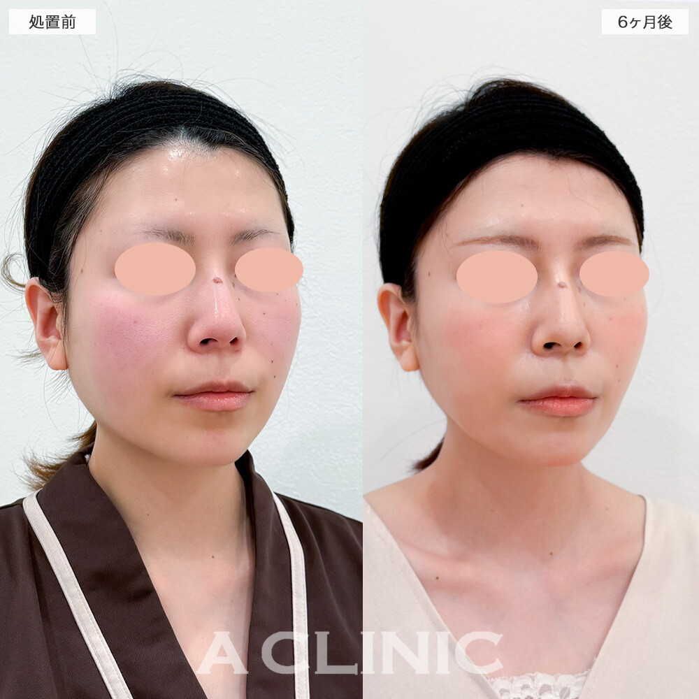 1day小顔脂肪吸引と小顔エラボトックスで顔の余白が一回り小さくなりました！処置前と6ヶ月後の症例です(30代女性)