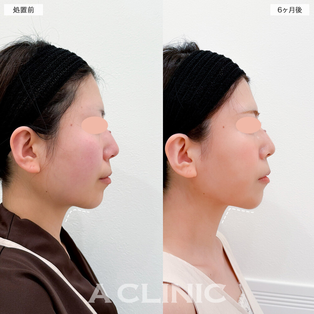 1day小顔脂肪吸引と小顔エラボトックスで顔の余白が一回り小さくなりました！処置前と6ヶ月後の症例です(30代女性)