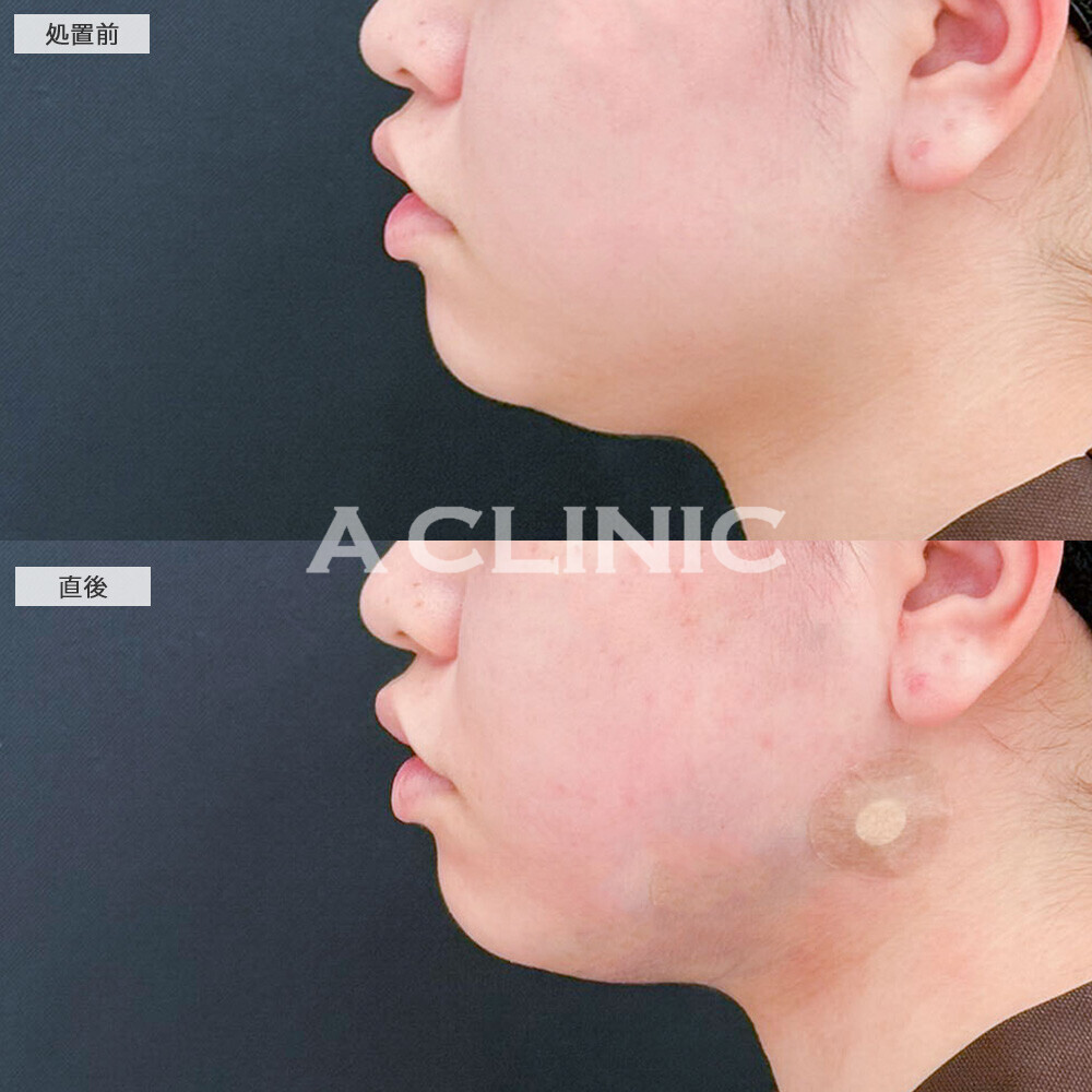 1day小顔脂肪吸引を受けると別人級の変化で垢抜け成功!処置前から2ヶ月後の症例です(10代女性)