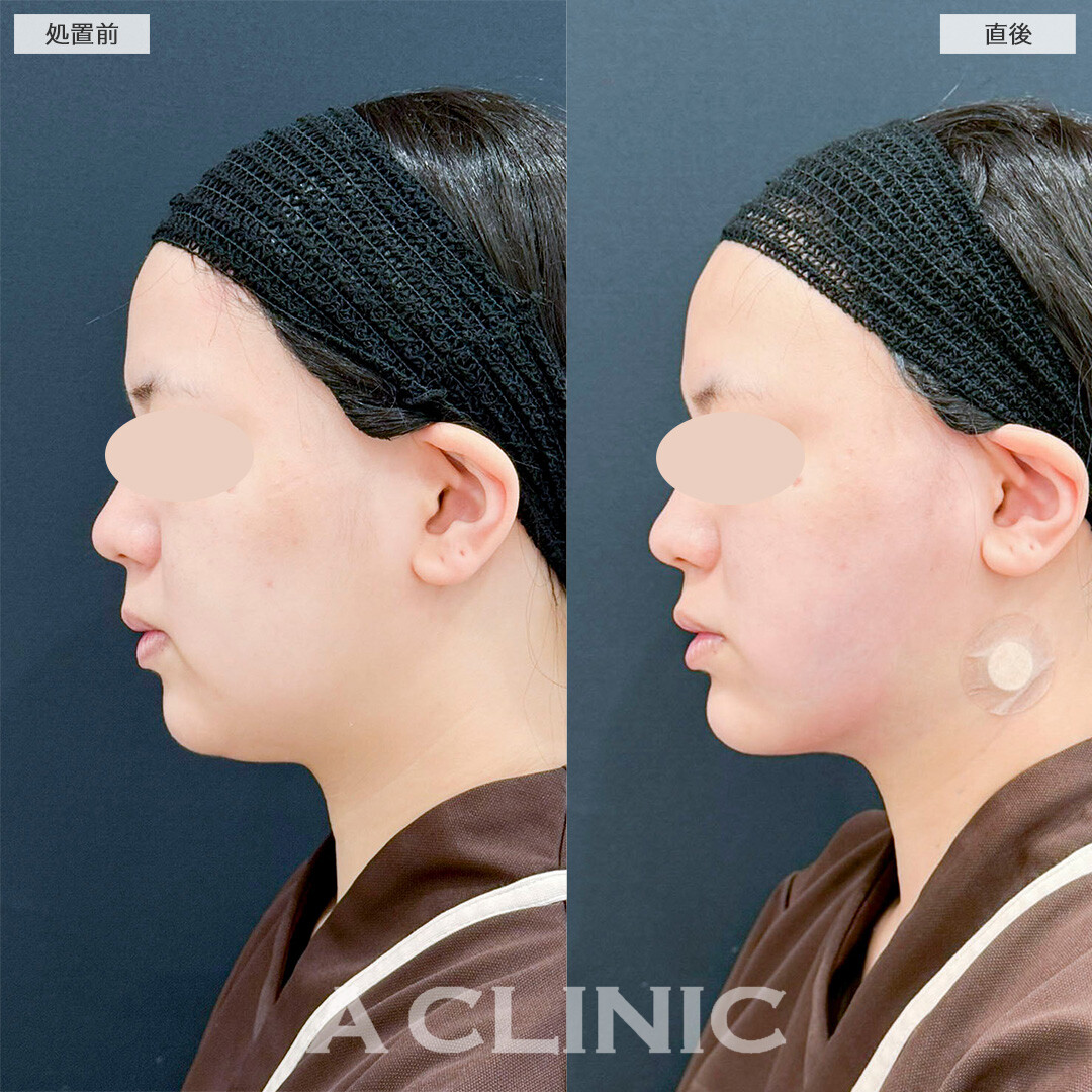 1day小顔脂肪吸引とあごへのヒアルロン酸注入の併用で直後から横顔が綺麗に！処置前と直後の症例です(20代女性)