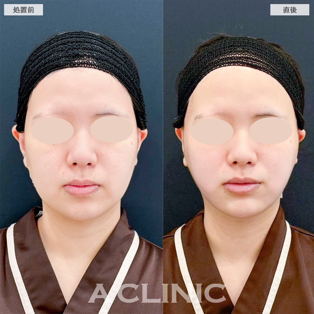 1day小顔脂肪吸引とあごへのヒアルロン酸注入の併用で直後から横顔が綺麗に！処置前と直後の症例です(20代女性)