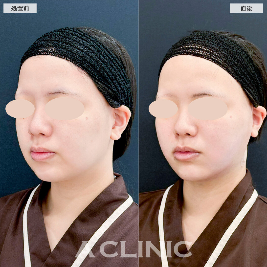 1day小顔脂肪吸引とあごへのヒアルロン酸注入の併用で直後から横顔が綺麗に！処置前と直後の症例です(20代女性)