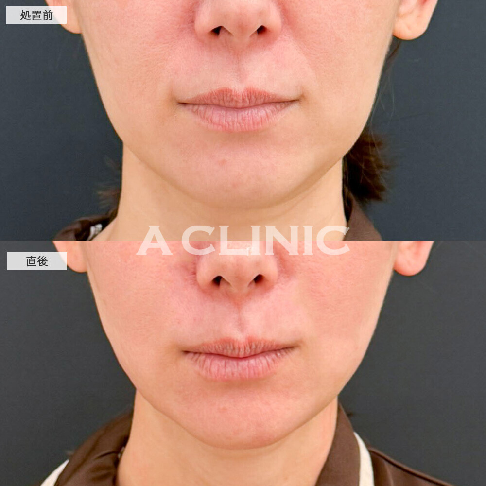 1day小顔脂肪吸引なら直後から腫れ最小限でこのスッキリ感!処置前と直後の症例です(40代女性)