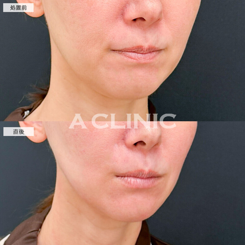 1day小顔脂肪吸引なら直後から腫れ最小限でこのスッキリ感!処置前と直後の症例です(40代女性)