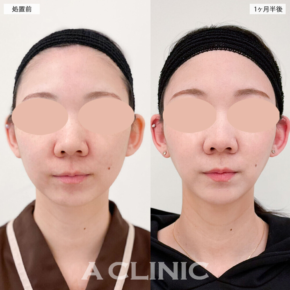 1day小顔脂肪吸引と小顔エラボトックスで余白のない卵型の輪郭に！こちら処置前から4ヶ月半後の症例です(30代女性)