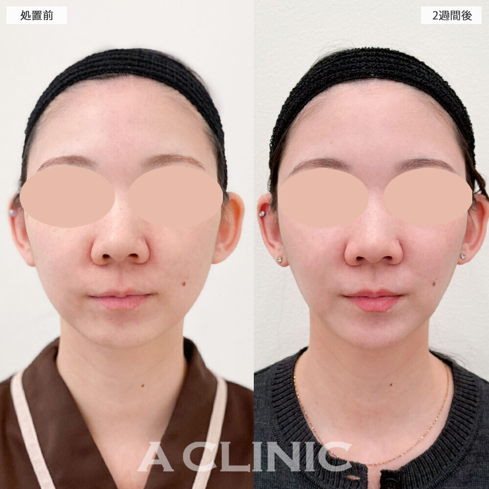 1day小顔脂肪吸引と小顔エラボトックスで余白のない卵型の輪郭に！こちら処置前から4ヶ月半後の症例です(30代女性)