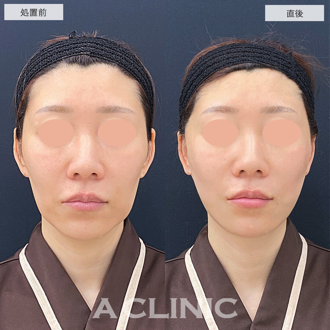 A式美肌たるみ切開と1day小顔脂肪吸引で下にたるんだ輪郭をキュッと上向きに!処置前と直後の症例です(40代女性)