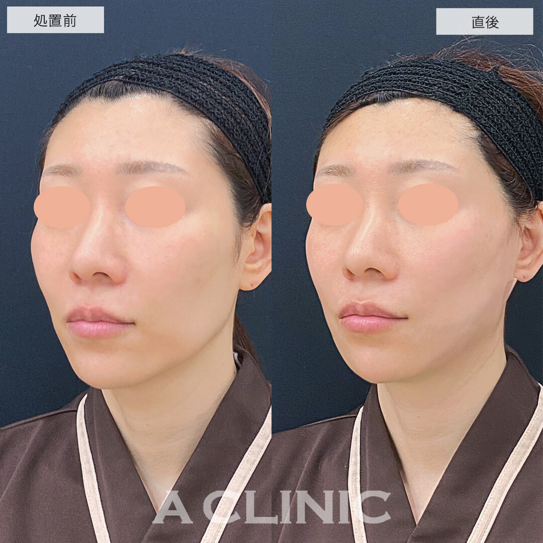 A式美肌たるみ切開と1day小顔脂肪吸引で下にたるんだ輪郭をキュッと上向きに!処置前と直後の症例です(40代女性)