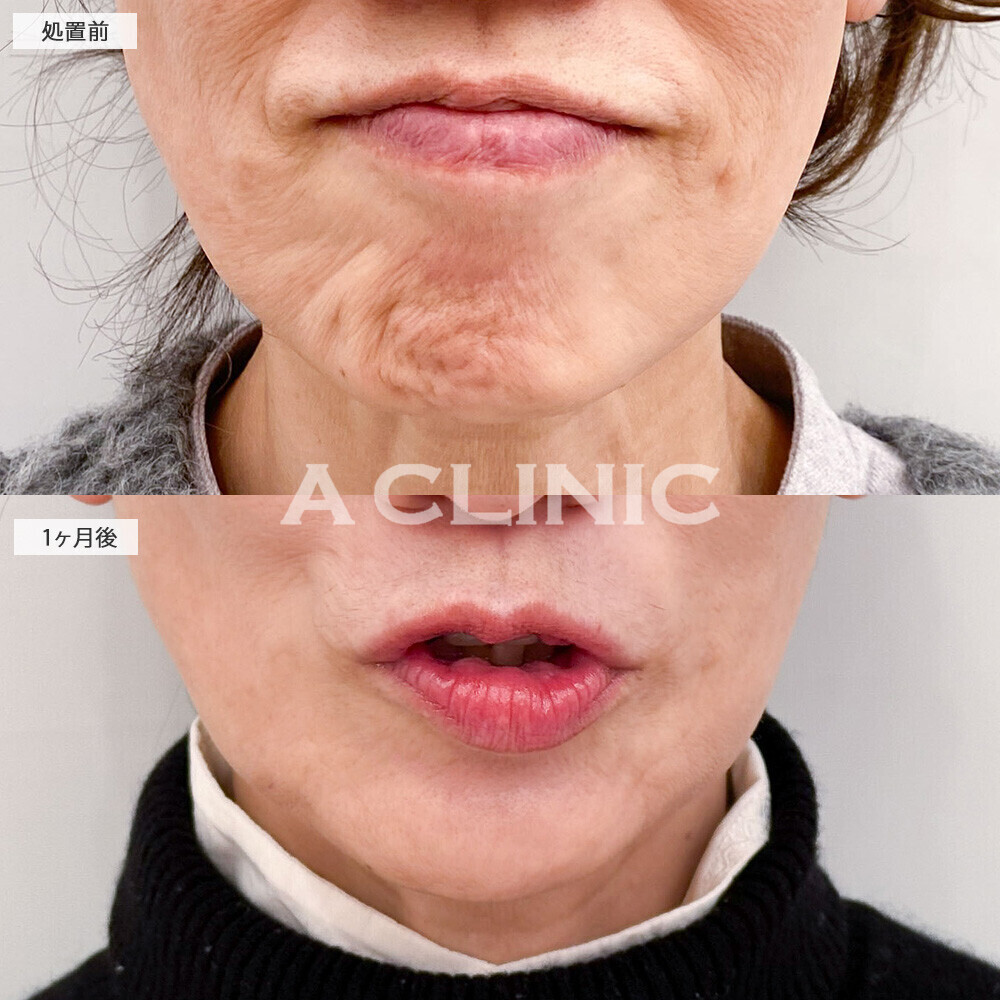 Aスレッドとボトックス注射(しわ)で深いしわも改善！こちら処置前から1ヶ月後の症例です(60代女性)