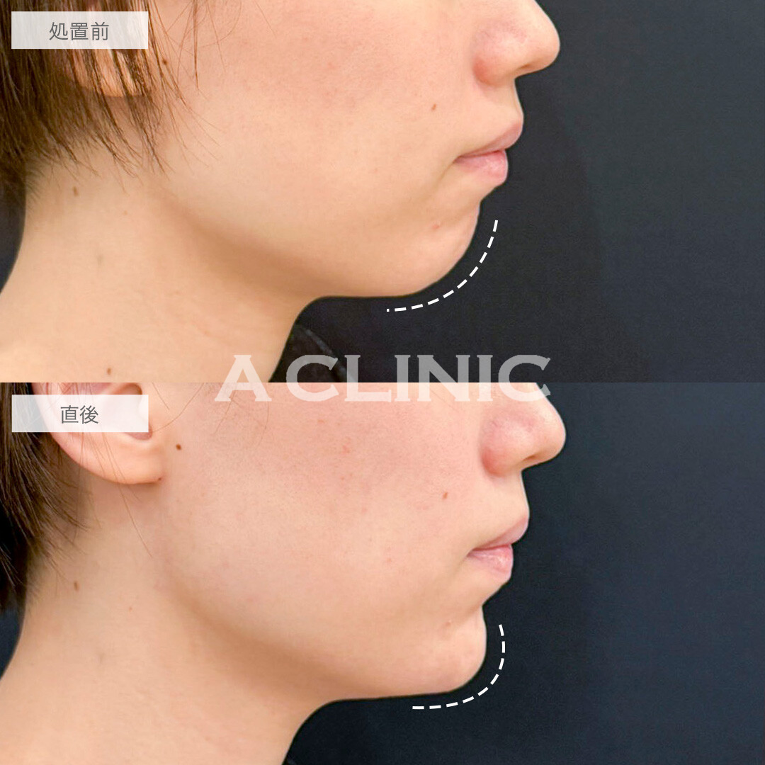 あごへのヒアルロン酸注入で顎先が整い横顔が美しくなりました！処置前と直後の症例です(20代女性)