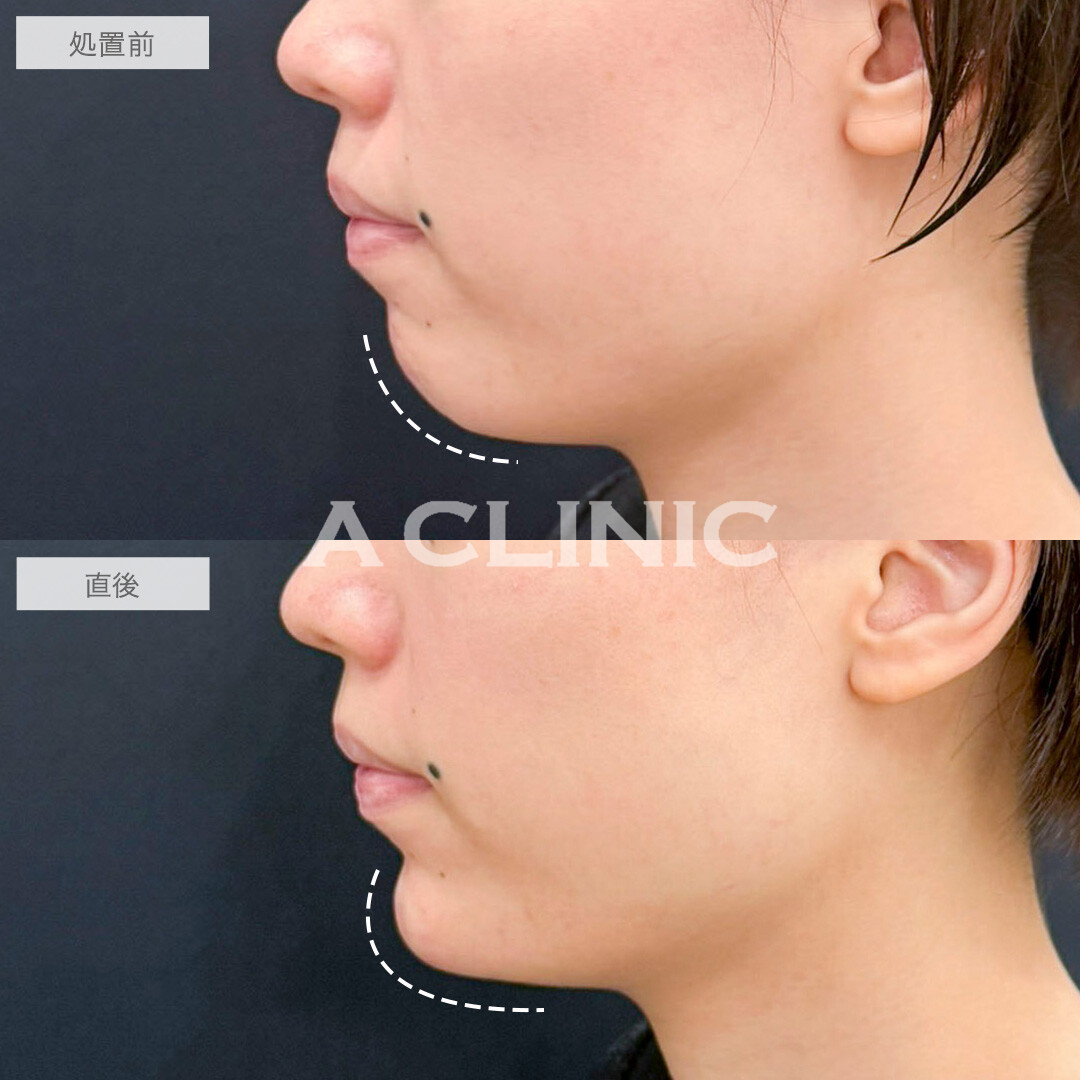あごへのヒアルロン酸注入で顎先が整い横顔が美しくなりました！処置前と直後の症例です(20代女性)