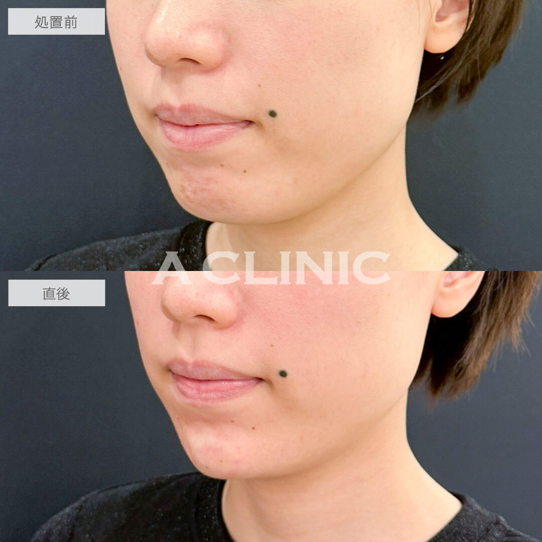 あごへのヒアルロン酸注入で顎先が整い横顔が美しくなりました！処置前と直後の症例です(20代女性)