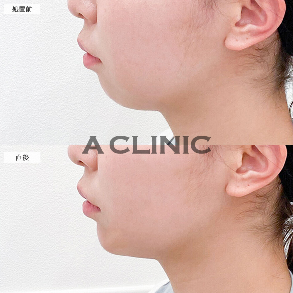 あごへのヒアルロン酸注入で短いアゴが解消されました!こちら処置前と直後の症例です(20代女性)